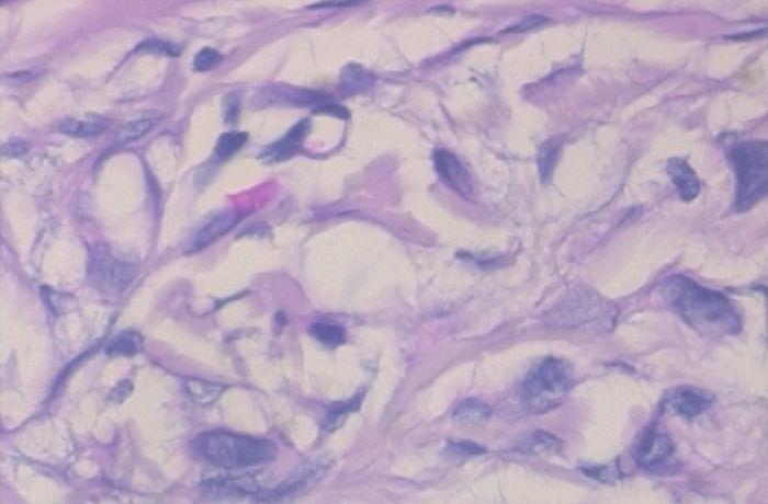 医学图像 | 使用深度学习实现乳腺癌分类（附python演练）