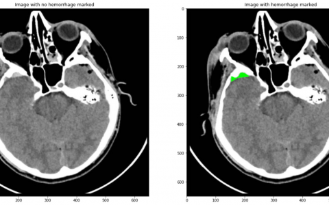 计算机视觉如何提高医生对颅内出血的诊断？